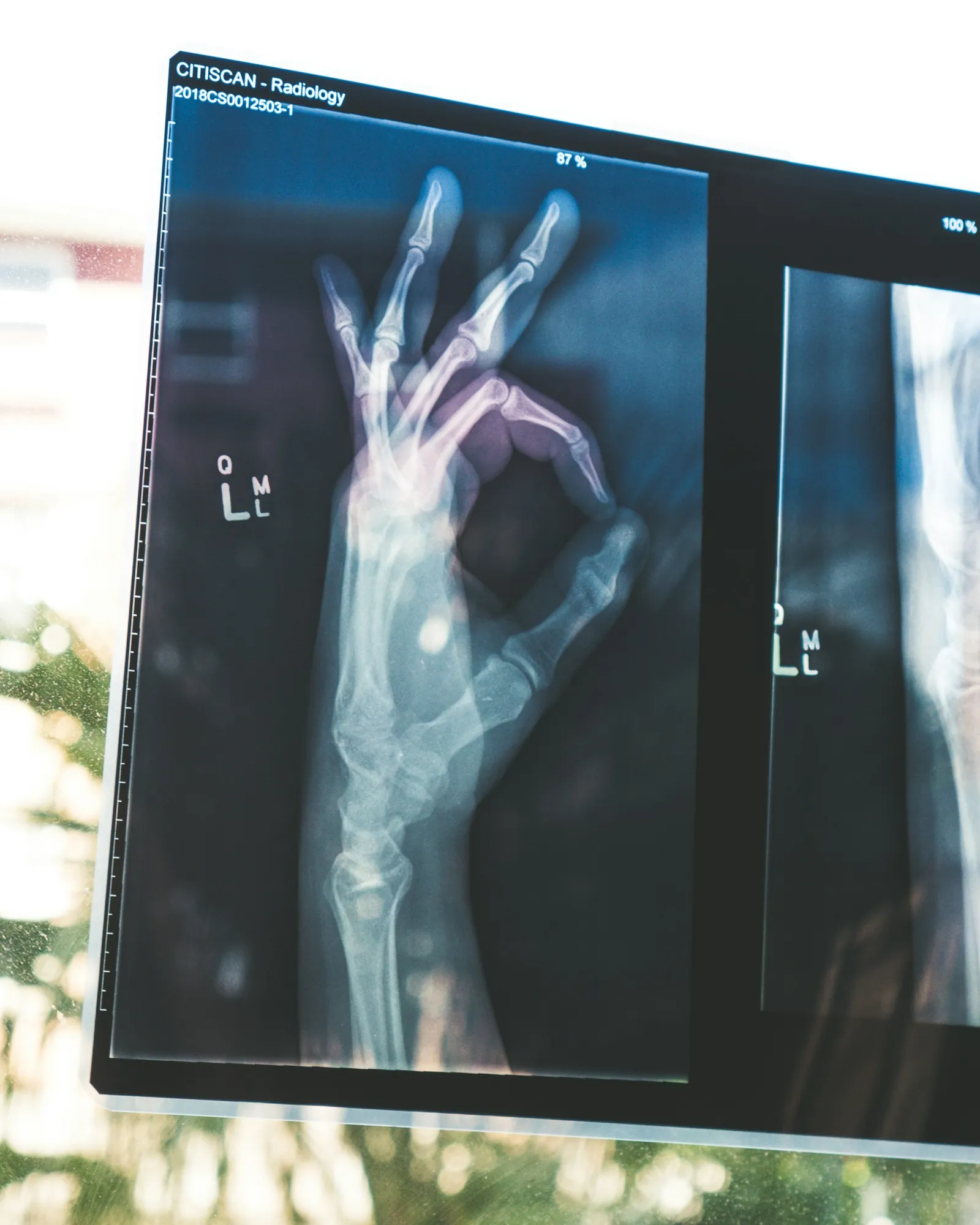 A hand radiograph on a viewing screen, the fingers making an OK sign
