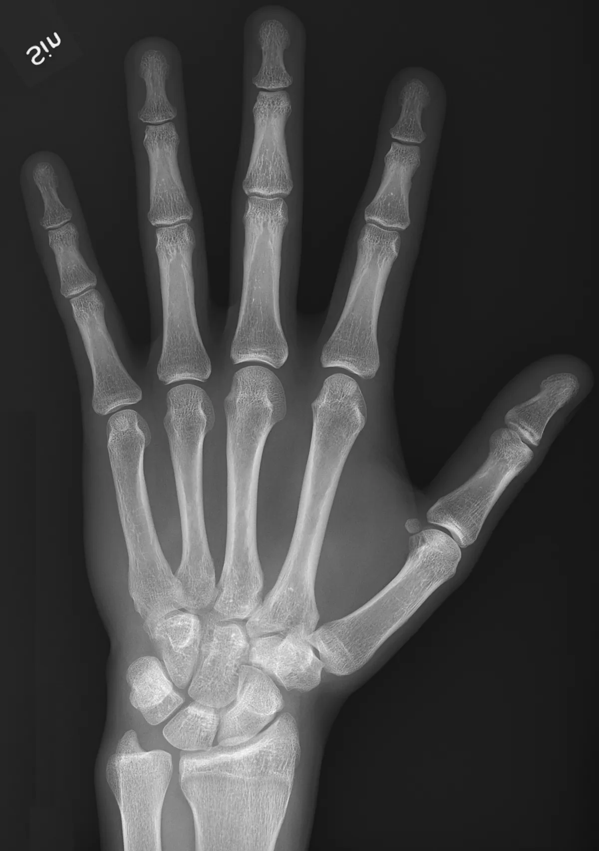 A hand radiograph with the joints a model has marked